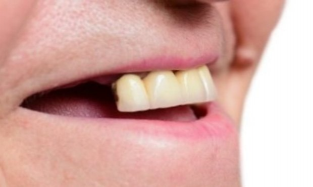 Pétition : Pour le remboursement de tous les soins dentaires en France (bridges, implants réservés aux riches)