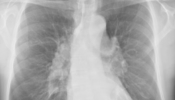 Mon fils David atteint depuis sept ans d’une sarcoïdose !