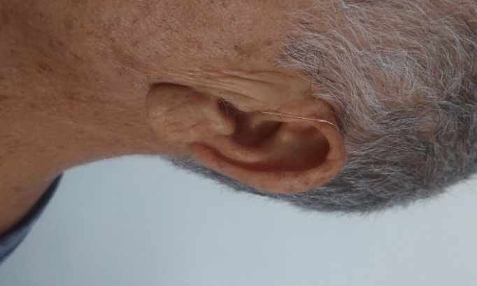 Il est urgent de trouver un traitement pour les accouphènes