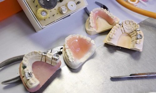 Interdiction des plombages au mercure dans les soins dentaires