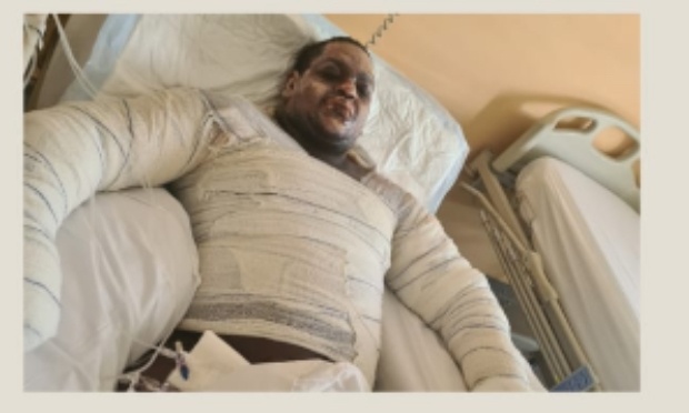 Pour une meilleure prise en charge des grands brûlés en Martinique