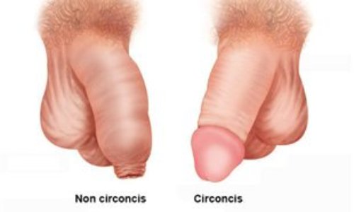 Reconnaitre les pr&eacute;judices engendr&eacute;s par la circoncision