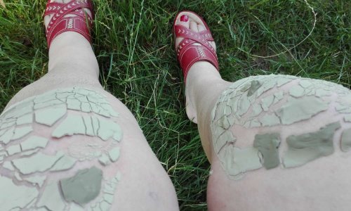 br&ucirc;lure par le froid tr&eacute;s profonde dans la cuisse