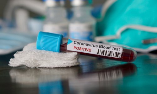 Coronavirus : craignez-vous le stade 3 de l’épidémie en France ?