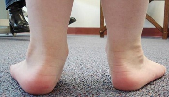 Pensez-vous qu'avoir les pieds plats présente un risque pour la santé humaine ?